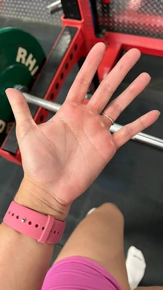 Mano castigada por la fricción de la barra en el gimnasio