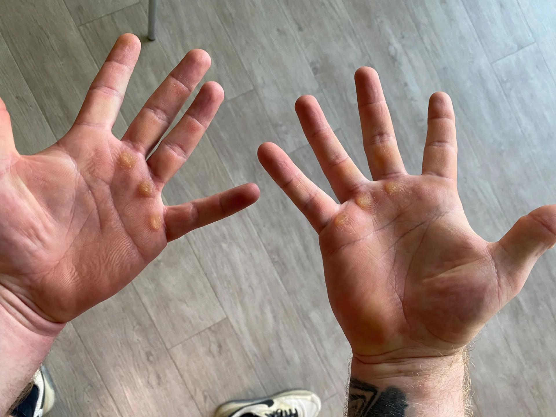 Palmas de las manos con callos y piel castigada después de entrenar